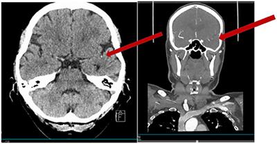 Acute Ischemic Stroke With Mild Symptoms–To Thrombolyse or Not to Thrombolyse?